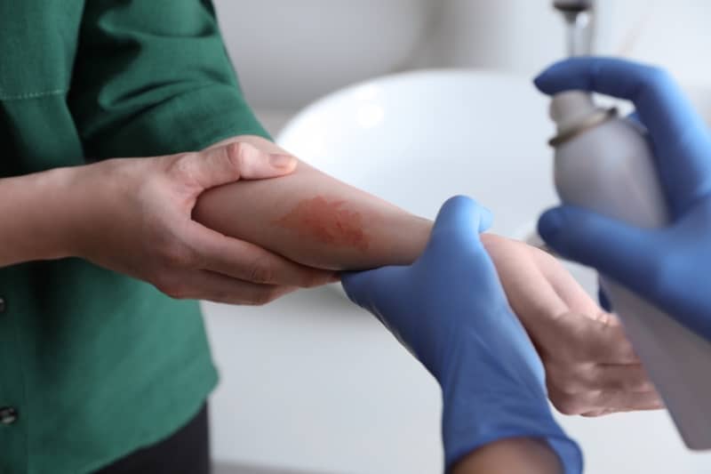 moist burn pads 5