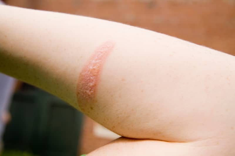 moist burn pads 8