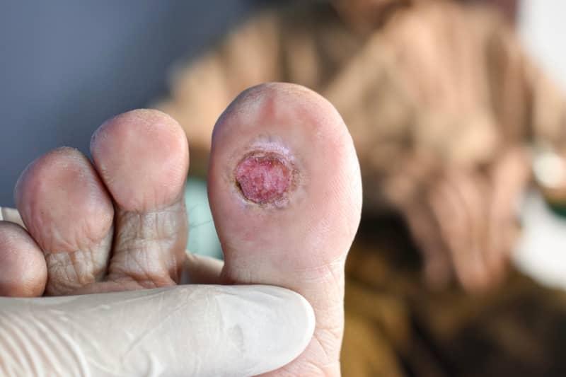 moist burn pads 2