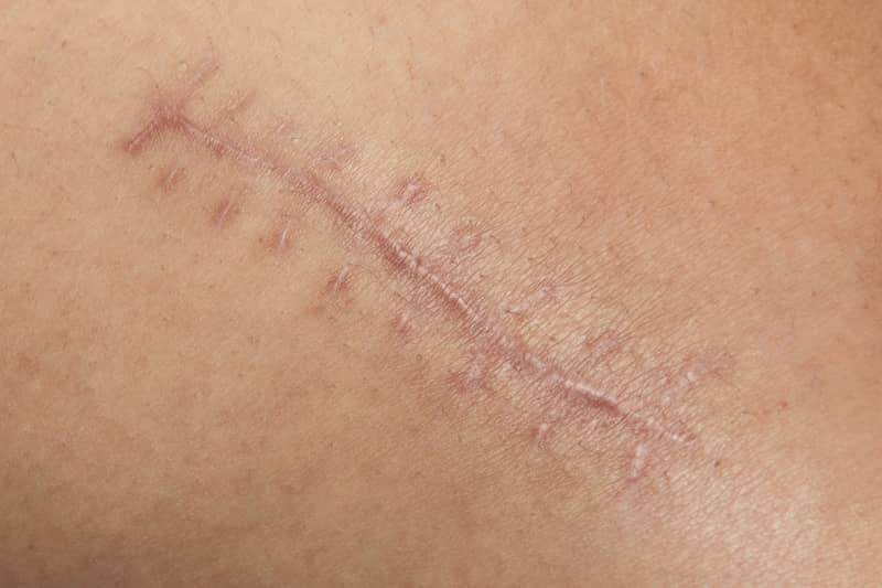 silicone scar patch