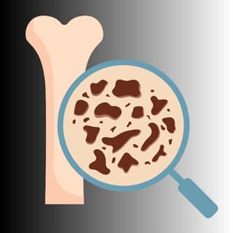 osteoporosis-improve bone health after 50